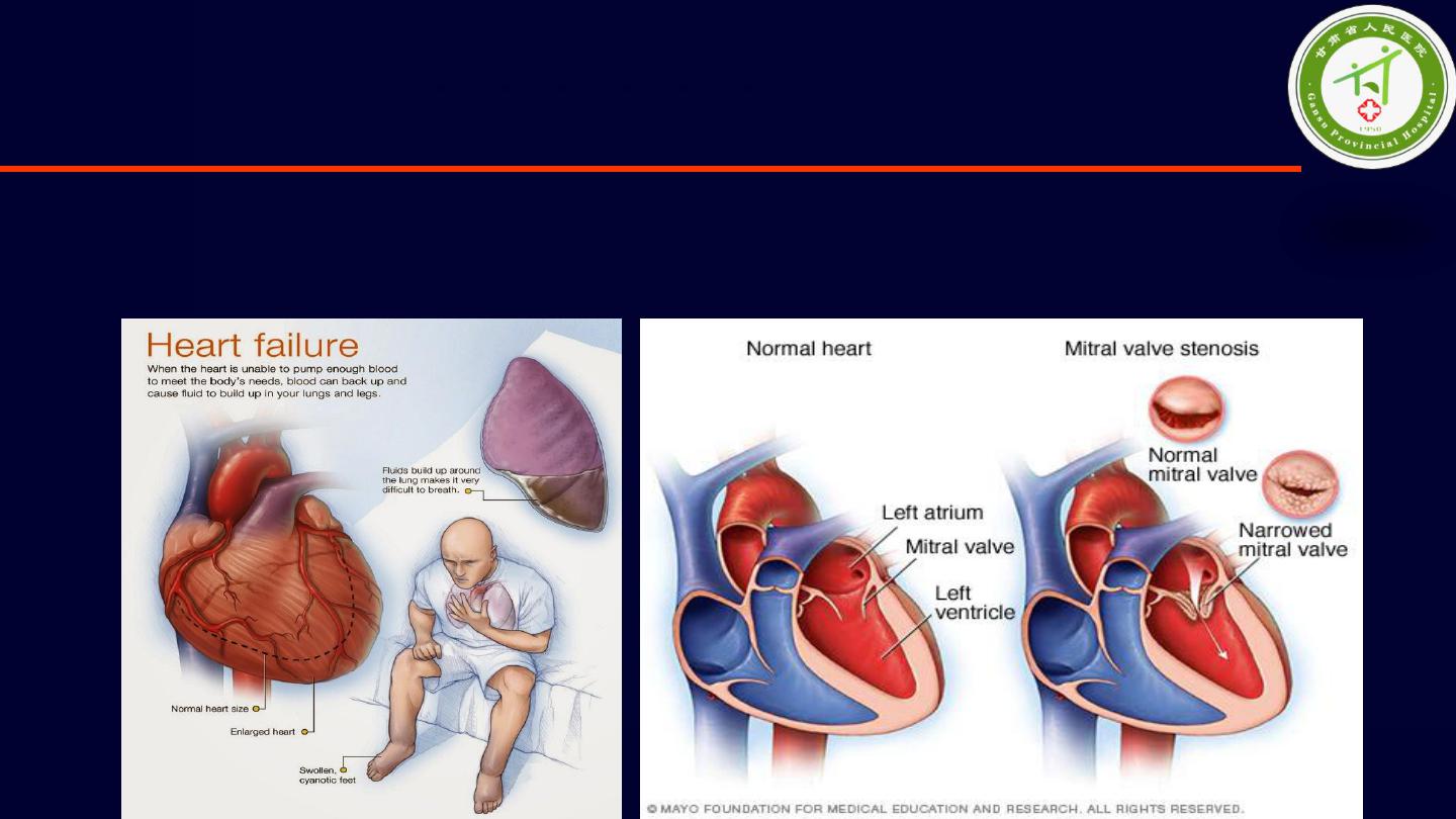 风湿性二尖瓣狭窄心衰1例